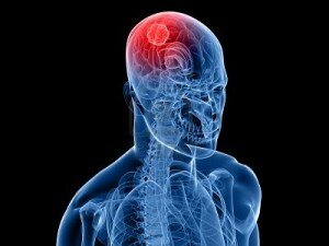 6003153-radiographie-t-te-humaine-avec-une-tumeur-c-r-brale-dans-le-cerveau