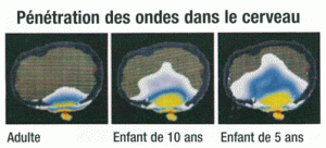 Epidémie de cancers du tronc cérébral à Saint-Cyr-L’Ecole